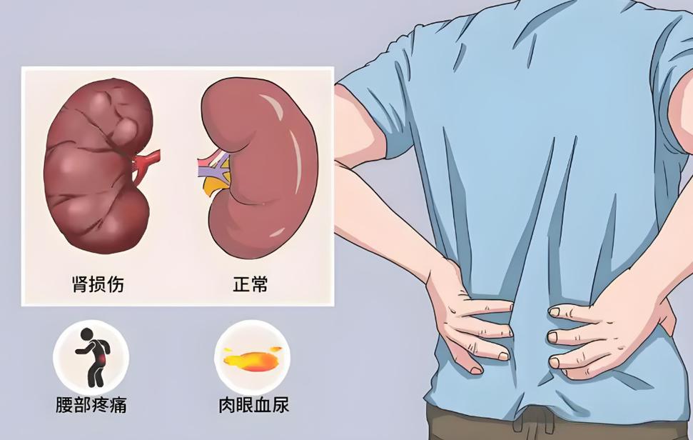肾病早期难察觉?警惕这 5 个 “健康警报”,早发现早干预